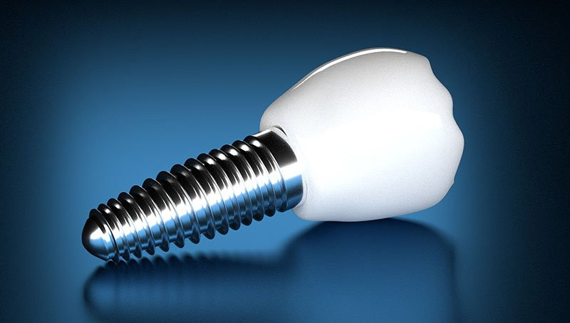 titanium tooth implant screw