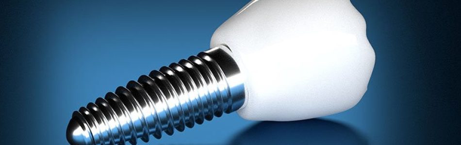 titanium tooth implant screw