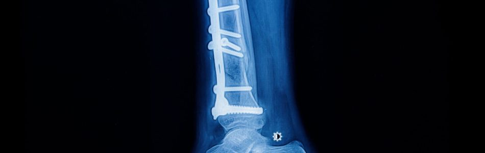 taitanium implant screws